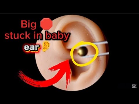 baby have stuck large amount of toy ||Asmr ear clean •