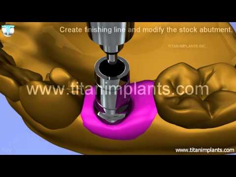 Life Core Open Tray Impression
