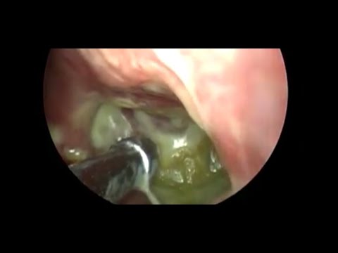 Slurrrrrrp! - Cleaning thick boogers out of the nose!