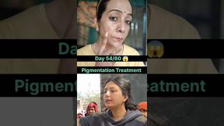 Pigmentation Treatment on Face #pigmentation #pigmentationsolution #skincare #beautytips #shortvideo