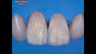 Direct Restoration Of Frontal Teeth