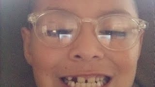 my tooth fall out