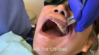 Dental Implant Crown. Screw Retained vs Cement Retained