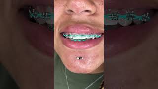 Best Braces Colors if you have Red Hair