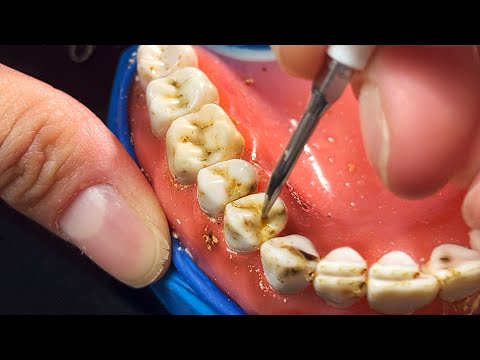 Gigantic Tartar Removal | Scaling