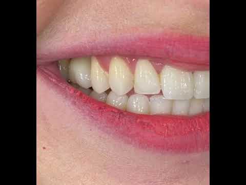 Jessica New Smile with Implants