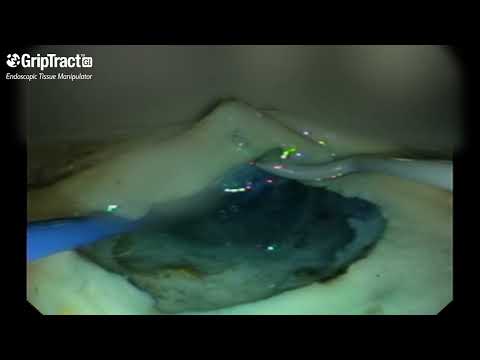 Dr.Pauli Review of GripTract GI Endoscopic Tissue Manipulator