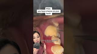 5 years worth of cheese build up on teeth. #cheese #tartarremoval #plaque #teethcleaning #dentist