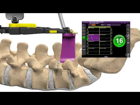 MAS PLIF Patient Education Animation US