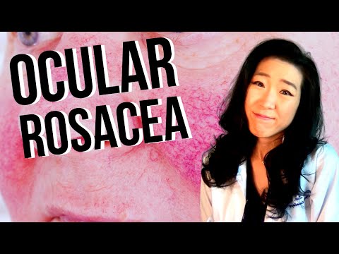 Ocular Rosacea | How Rosacea Can Affect Your Eyes!