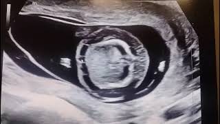 Why NT scan during pregnancy  is very important ? Check this out ….Dr Kishan Bhagwat. Fetal imaging 