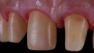 Digital Impression : Veneers and Crowns by True Definiton Scanner
