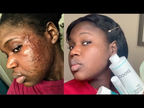 (UPDATE)Proactive Acne Solutions Saved My LIFE (AFTER ONE YEAR)