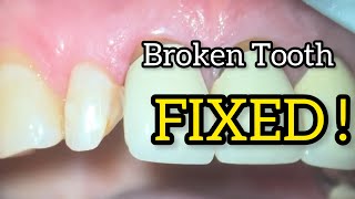 Class IV Composite Restoration | Step-by-Step Anterior Tooth Build-Up