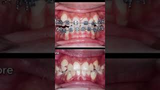 braces #dentist #smiledesigndental #dentaltreatment #dentalartistry #dentalbraces #satisfying