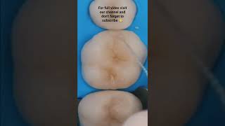 Dental restoration #dental #dentalworld #dentalwork #oralcare #oralhealthcare #oralhealth #dentistry