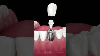 Dental implant installation and crown placement #dentalimplants #implants #teeth