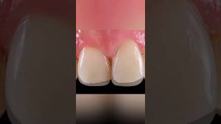 ↩️↪️Before and after | case 42 | Direct Composite Restoration | Your Dentist #shorts #shortvideo