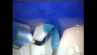 Bioclear - Peg Lateral