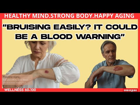 Bruising Easily? Your Blood May Be Telling You Something Alarming: Healthy Aging- Wellness 60–100