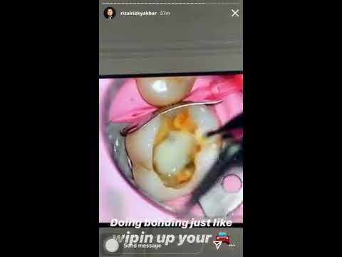 Cavity liner using Ionoseal