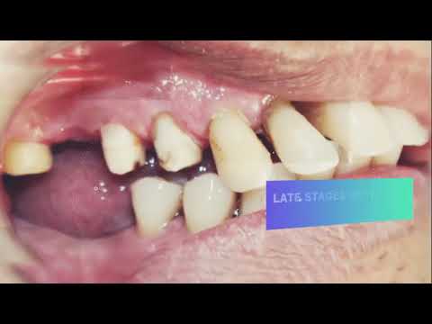 Here's why Oral Hygiene is very important | Calculus deposits | Gum bleeding | Teeth loss
