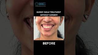 No more hiding that smile! Correct your gummy smile without surgery and embrace your best self.