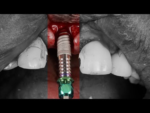 Anterior Implant Placement Demo