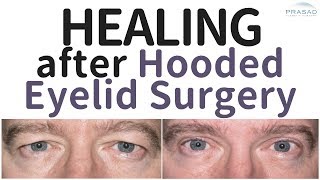 What Healing is Like After Upper Eyelid Blepharoplasty