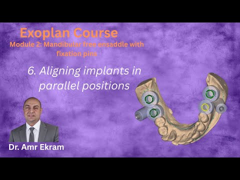 6  Aligning implants in parallel position in Exoplan