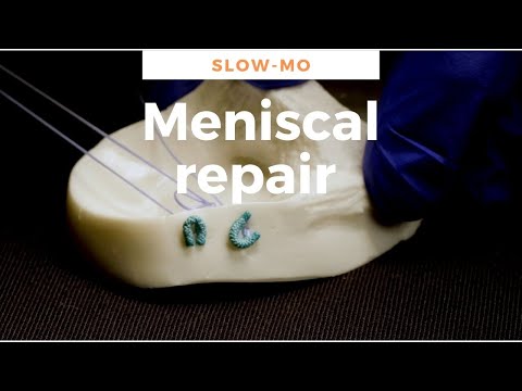 Meniscus repair using FiberStitch all inside suture repair - 1/5th speed