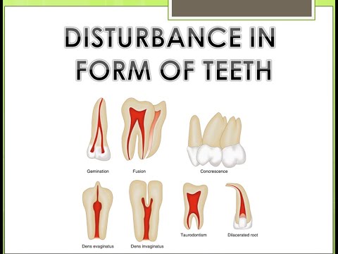 disturbance in form of teeth
