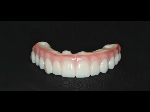 Full Arch Digital Upper with Lower Restorative