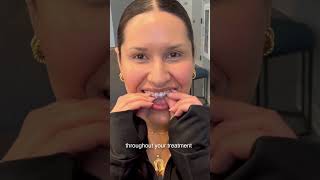 Why Some People Choose Invisalign Over Braces 🦷