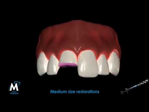 The benefits of using HRi composite from Micerium