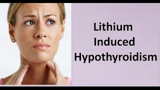 Lithium Induced Hypothyroidism