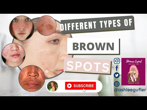 DIFFERENT TYPES OF BROWN SPOTS | Ashlee Gufler