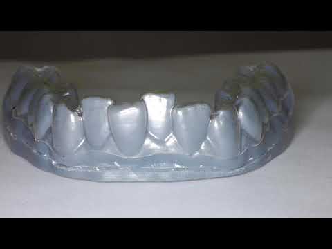 Clear Aligners 3D Printed by: Nirenblatt Orthodontics