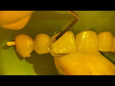 FAST & EASY way to close a tooth gap with composite