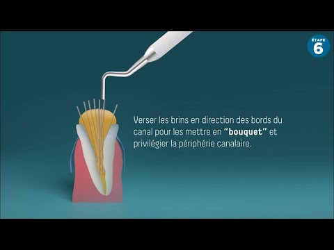 Utilisation du système multi-tenons fibrés Biolight® Drill-Free