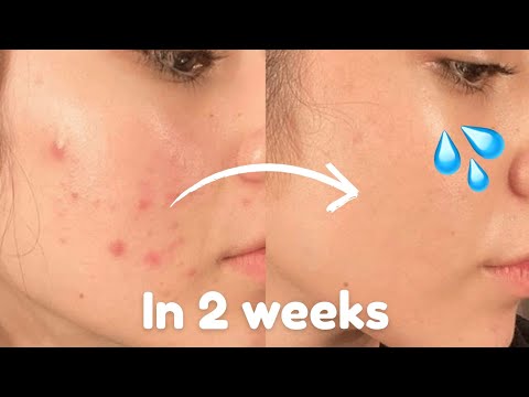 How YOU can get CLEAR SKIN in just 14 days 🔥😱 *Science Backed*