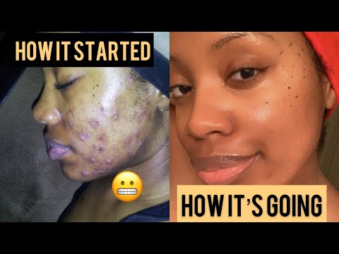 Skin Care Routine for Acne prone skin (Morning and Night)