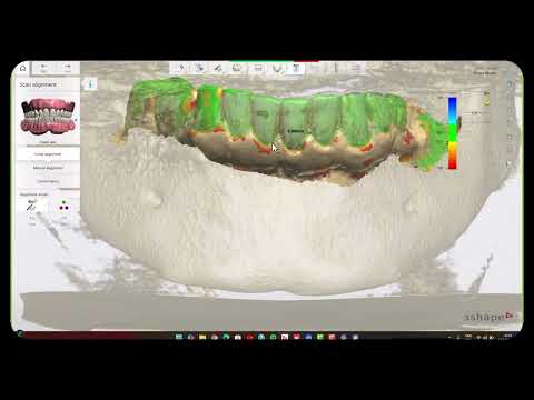 3Shape Unite Implant Studio Tutorial: Surgical Guide Design Made Simple