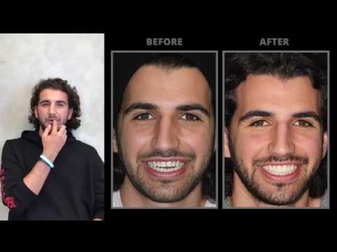 Achieving Natural and Perfect Teeth: My Veneers Journey