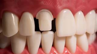 Full Ceramic Crown Prep #8 (rounded shoulder) - Dr. Mark R. Taylor