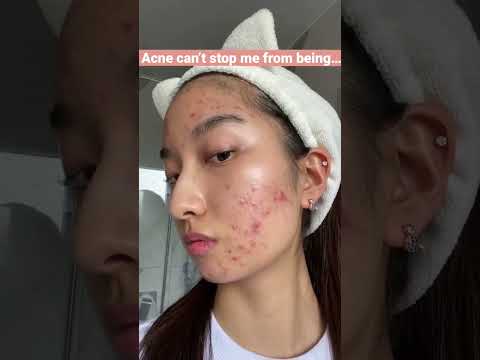 Watch My Acne Journey #shorts