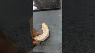 #smiledesign #dentist #dentakings #dmls #emax #pfm #dentalprosthesis  #dentaltreatments #implant