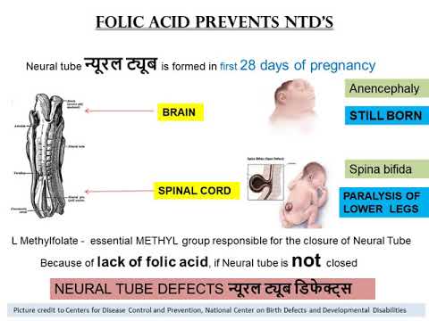 Neural Tube Defects 22ndMarch2020