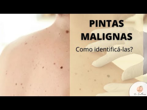 Como identificar uma pinta maligna? - Dr. Guilherme Ferreira
