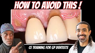 How To Improve Clinical Outcomes With Periodontal Tooth Lengthening (For General Dentists)